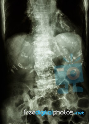 Spondylosis Stock Photo