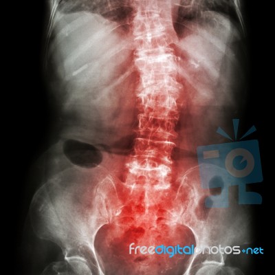 Spondylosis And Scoliosis ( Film X-ray Lumbar - Sacrum Spine Show Crooked Spine ) ( Old Patient ) ( Spine Healthcare ) Stock Photo