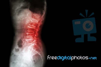 Spondylosis , Spondylolisthesis  ( Film X-ray Lumbo - Sacral Spine Show Spine Collapse , Decrease In Disc Space , Bony Spur Formation ) ( Side , Lateral View ) And Blank Area At Right Side Stock Photo