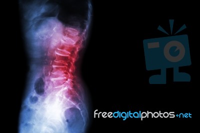 Spondylosis , Spondylolisthesis  ( Film X-ray Lumbo - Sacral Spine Show Spine Collapse , Decrease In Disc Space , Bony Spur Formation ) ( Side , Lateral View ) And Blank Area At Right Side Stock Photo