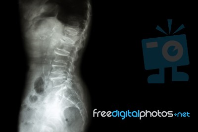 Spondylosis , Spondylolisthesis  ( Film X-ray Lumbo - Sacral Spine Show Spine Collapse , Decrease In Disc Space , Bony Spur Formation ) ( Side , Lateral View ) And Blank Area At Right Side Stock Photo