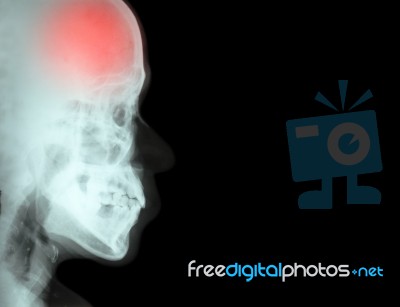 Stroke ( Cerebrovascular Accident ) ( Film X-ray Skull Lateral With Stroke ) And Blank Area At Right Side ( Medical And Science And Healthcare Background ) Stock Photo