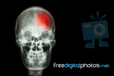 Stroke ( Cerebrovascular Accident ) . Film X-ray Skull Of Human With Red Area ( Medical , Science And Healthcare Concept And Background ) Stock Photo