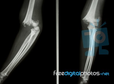 Supracondylar Humerus Fracture Stock Photo