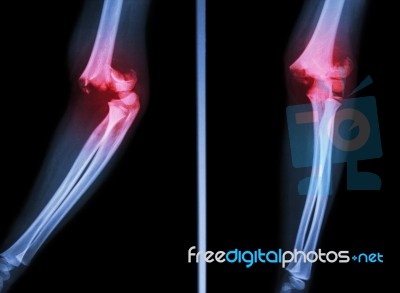 Supracondylar Humerus Fracture Stock Photo