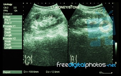 Ultrasonography Of Kidney : Show Left Kidney Stone ( 2 Image For Compare ) Stock Photo