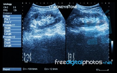 Ultrasonography Of Kidney : Show Left Kidney Stone ( 2 Image For Compare ) Stock Photo