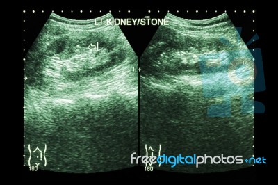 Ultrasonography Of Kidney : Show Left Kidney Stone ( 2 Image For Compare ) Stock Photo