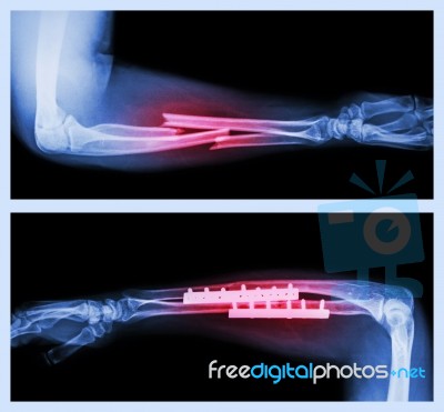 Upper Image : Fracture Ulnar And Radius (forearm Bone) , Lower Image : It Was Operated And Internal Fixed With Plate And Screw Stock Photo