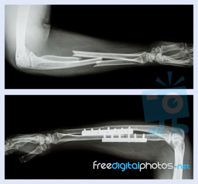 Upper Image : Fracture Ulnar And Radius (forearm Bone) , Lower Image : It Was Operated And Internal Fixed With Plate And Screw Stock Photo