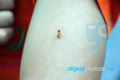 Was Bitten By Ant On The Arm Stock Photo