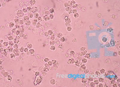 White Blood Cells In Urine Stock Photo - Royalty Free Image ID 100475080