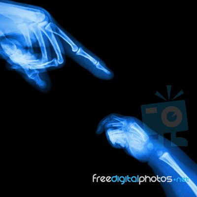 X-ray Adult's Hand Point Finger At Upper Side And Baby's Hand At Lower Side Stock Photo