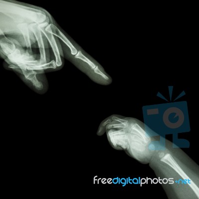 X-ray Adult's Hand Point Finger At Upper Side And Baby's Hand At Lower Side Stock Photo