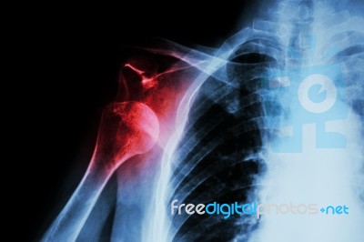 X-ray Anterior Shoulder Dislocation Stock Photo