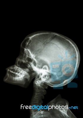 X-ray Asian Kid Look Up And Blank Area At Upper Side Stock Photo