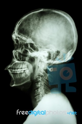 X-ray Asian Skull And Cervical Spine Stock Photo