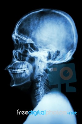 X-ray Asian Skull And Cervical Spine Stock Photo