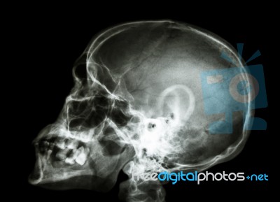 X-ray Asian Skull And Cervical Spine Stock Photo