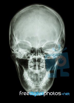 X-ray Asian Skull (thai People) Stock Photo