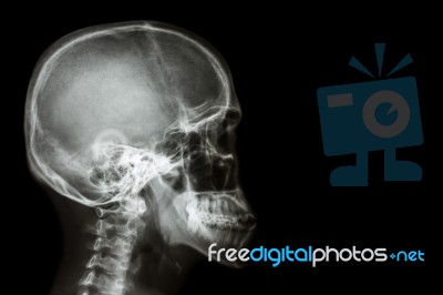 X-ray Asian Skull (thai People) And Blank Area At Right Side Stock Photo