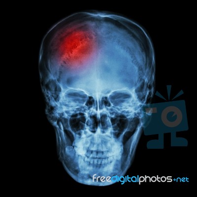 X-ray Asian Skull (thai People) And Headache Stock Photo