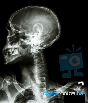 X-ray Asian Skull(thai People),cervical Spine,both Shoulder And Stock Photo