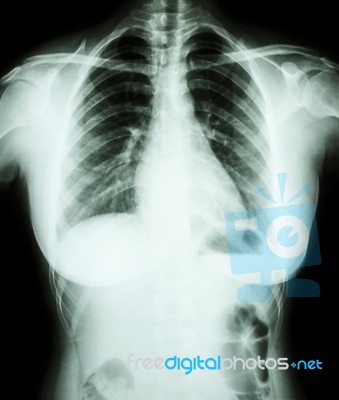 X-ray Asian Woman (thai People) Stock Photo