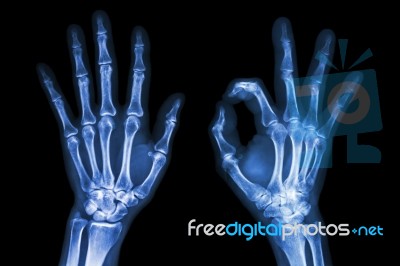 X-ray Both Hands With Ok Sign Stock Photo