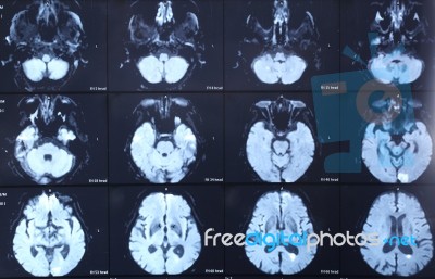 X-ray Brain Film Stock Photo