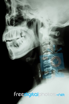 X-ray Cervical Spine Of Asian People Stock Photo