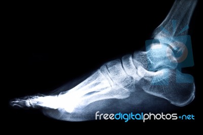 X-ray Film Stock Photo