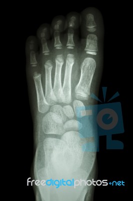 X-ray Foot Ap : Show Normal Child's Foot Stock Photo