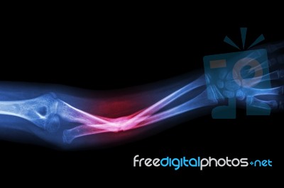 X-ray Fracture Ulnar Bone (forearm Bone) Stock Photo