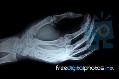 X-ray Hand Stock Photo