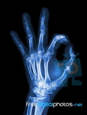 X-ray Hand With Ok Symbol Stock Photo