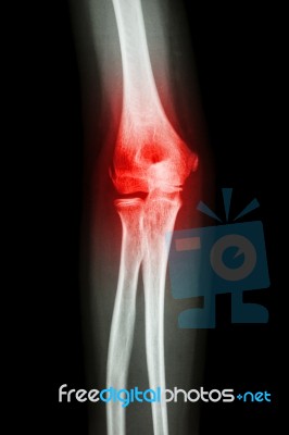 X-ray Human's Elbow And Arthritis (gout , Rheumatoid) Stock Photo