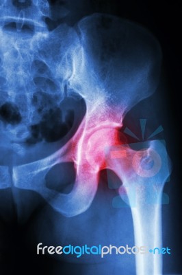 X-ray Left Hip And Arthritis Left Hip Stock Photo