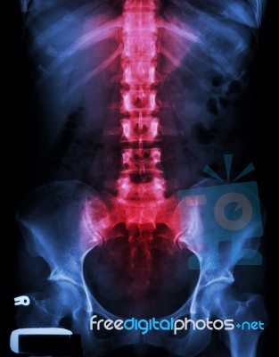 X-ray Lumbo-sacral Spine And Pelvis And Inflammation At Spine Stock Photo