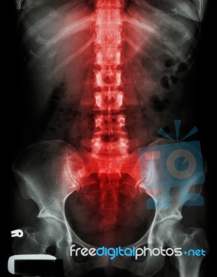 X-ray Lumbo-sacral Spine And Pelvis And Inflammation At Spine Stock Photo