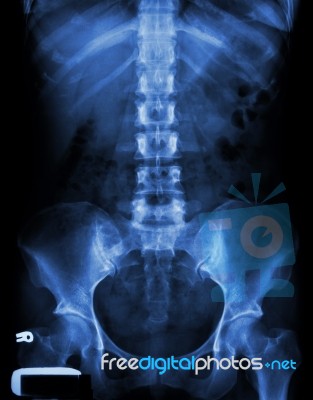 X-ray Lumbo-sacral Spine And Pelvis Of Asian Adult People Stock Photo