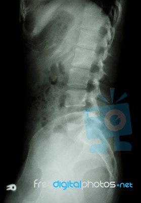 X-ray Lumbo-sacral Spine (lateral) Of Asian Adult People Stock Photo