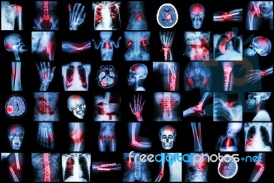 X-ray Multiple Disease Of Child And Adult ( Stroke , Arthritis , Fracture , Tuberculosis , Brain Tumor , Bowel Obstruction  , Kidney Stone , Spondylosis , Spondylolisthesis , Osteoarthritis Knee ,etc) Stock Photo