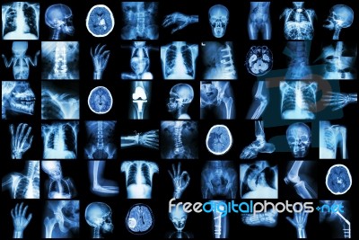 X-ray Multiple Part Of Adult And Child And Disease ( Pulmonary Tuberculosis Stroke Kidney Stone Osteoarthritis Bone Fracture Bowel Obstruction Spondylosis Spondylolisthesis Scoliosis Brain Tumor Etc) Stock Photo