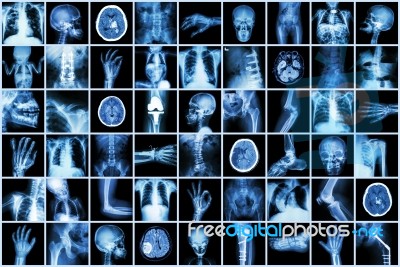 X-ray Multiple Part Of Adult And Child And Disease ( Pulmonary Tuberculosis Stroke Kidney Stone Osteoarthritis Bone Fracture Bowel Obstruction Spondylosis Spondylolisthesis Scoliosis Brain Tumor Etc) Stock Photo