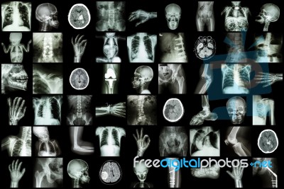 X-ray Multiple Part Of Adult And Child And Disease ( Pulmonary Tuberculosis Stroke Kidney Stone Osteoarthritis Bone Fracture Bowel Obstruction Spondylosis Spondylolisthesis Scoliosis Brain Tumor Etc) Stock Photo