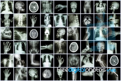 X-ray Multiple Part Of Adult And Child And Disease ( Pulmonary Tuberculosis Stroke Kidney Stone Osteoarthritis Bone Fracture Bowel Obstruction Spondylosis Spondylolisthesis Scoliosis Brain Tumor Etc) Stock Photo