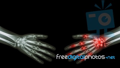 X-ray Normal Person Is Shaking Hand With Arthritis Hand Person Stock Photo