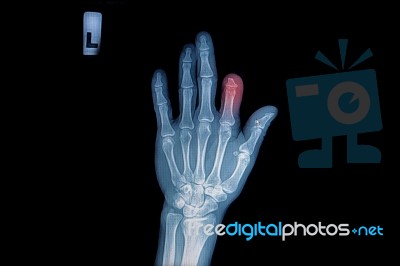 X-ray Of Trauma Hand And Loss Finger Stock Photo