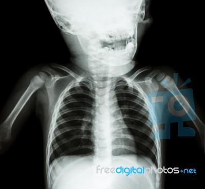 X-ray Skull And Chest Of Child Stock Photo